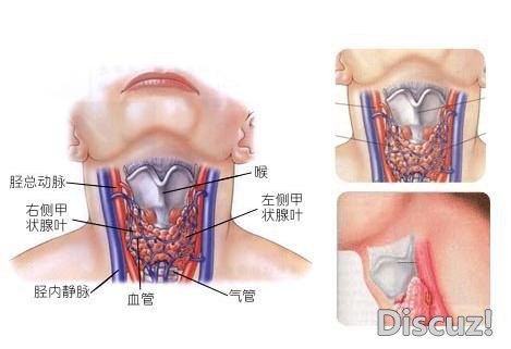 甲状腺结节.jpg